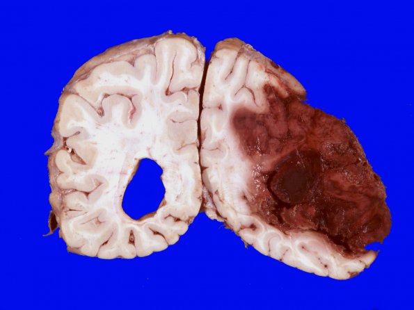 7B5 Infarct, hemorrhagic (Case 7) 8