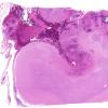 7C1 Infarct, hemorrhagic (Case 7) N15 H&E WM