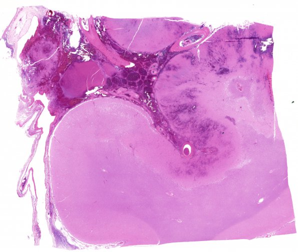 7C1 Infarct, hemorrhagic (Case 7) N15 H&E WM