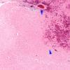 7C2 Infarct, hemorrhagic (Case 7) N16 H&E 4X 2 copy