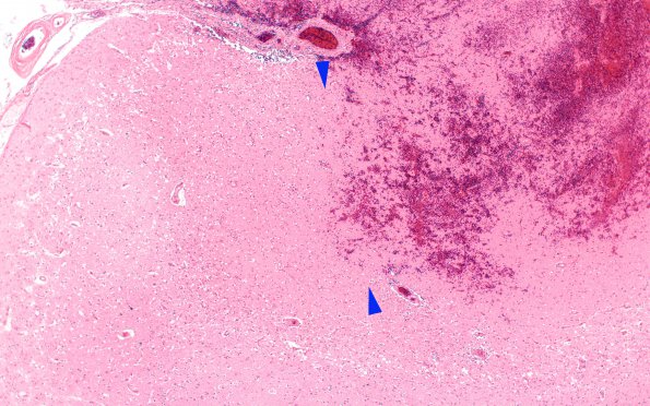 7C2 Infarct, hemorrhagic (Case 7) N16 H&E 4X 2 copy