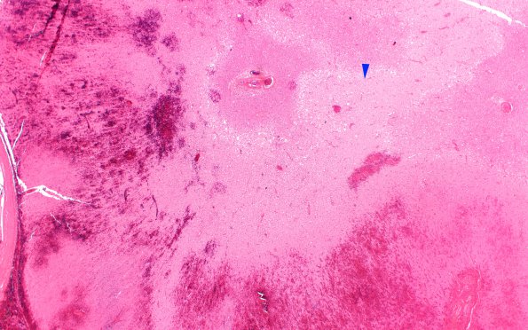 7C3 Infarct, hemorrhagic (Case 7) N15 H&E 2X copy