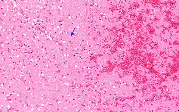 7C4 Infarct, hemorrhagic (Case 7) N16 H&E 20X 2 copy