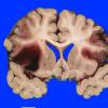 8A2 Infarct, hemorrhagic (Case 8) 2 (2)