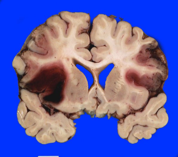 8A2 Infarct, hemorrhagic (Case 8) 2 (2)