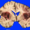 8A4 Infarct, hemorrhagic (Case 8) 3 (2)