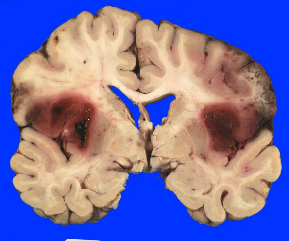 8A4 Infarct, hemorrhagic (Case 8) 3 (2)