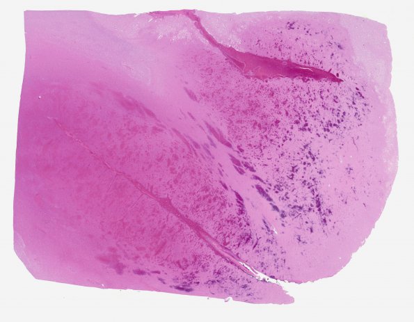 8B Infarct, hemorrhagic (Case 8) L1 WM