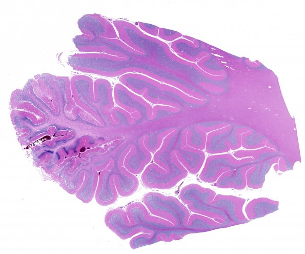 8C1 Infarct, hemorrhagic (Case 8) R14 WM