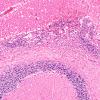 8C3 Infarct, hemorrhagic (Case 8) R14 10X