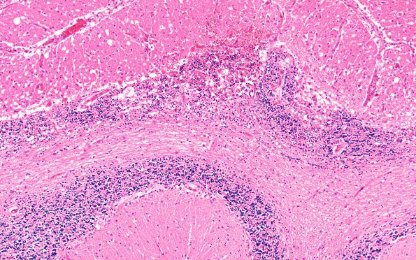 8C3 Infarct, hemorrhagic (Case 8) R14 10X