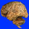 9A1 Infarct, hemorrhagic (Case 9) 3