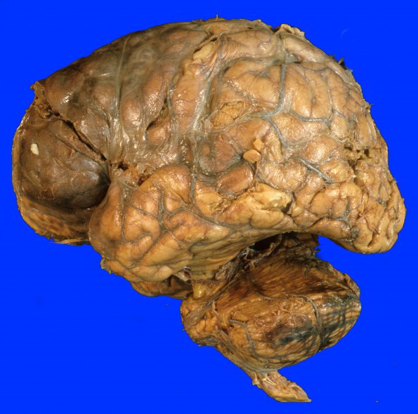 9A1 Infarct, hemorrhagic (Case 9) 3