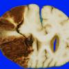 9A2 Infarct, Hemorrhagic (Case 9) a