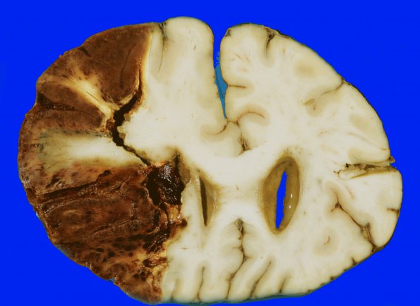 9A2 Infarct, Hemorrhagic (Case 9) a