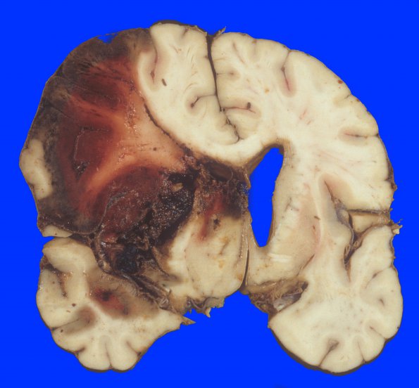 9A3 Infarct, hemorrhagic (Case 9) 1