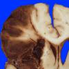 9A4 Infarct, hemorrhagic (Case 9) 2