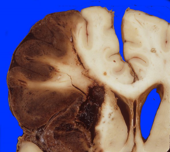 9A4 Infarct, hemorrhagic (Case 9) 2