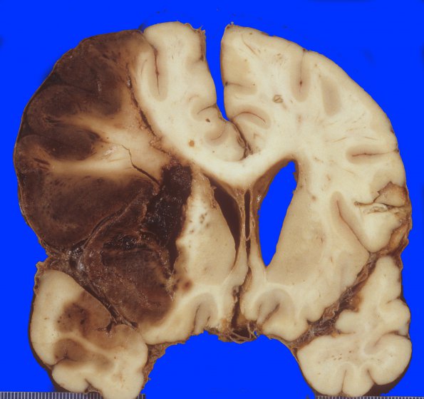 9A5 Infarct, hemorrhagic (Case 9) 4