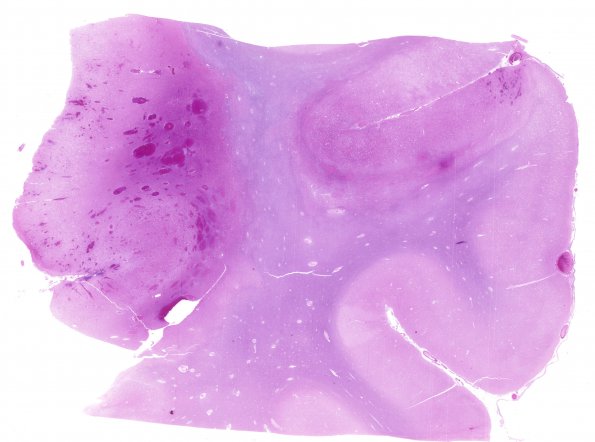 9B1 Infarct, hemorrhagic (Case 9) N11 H&E WM 2