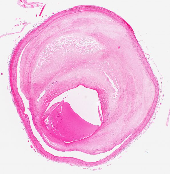 9B2 Infarct, hemorrhagic (Case 9) N12 H&E 2X