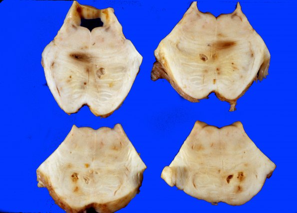 10B1 Infarct, Lacunar (Case 10B1)