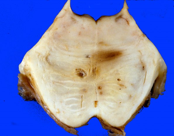 10B2 Infarct, Lacunar (Case 10B2) 2