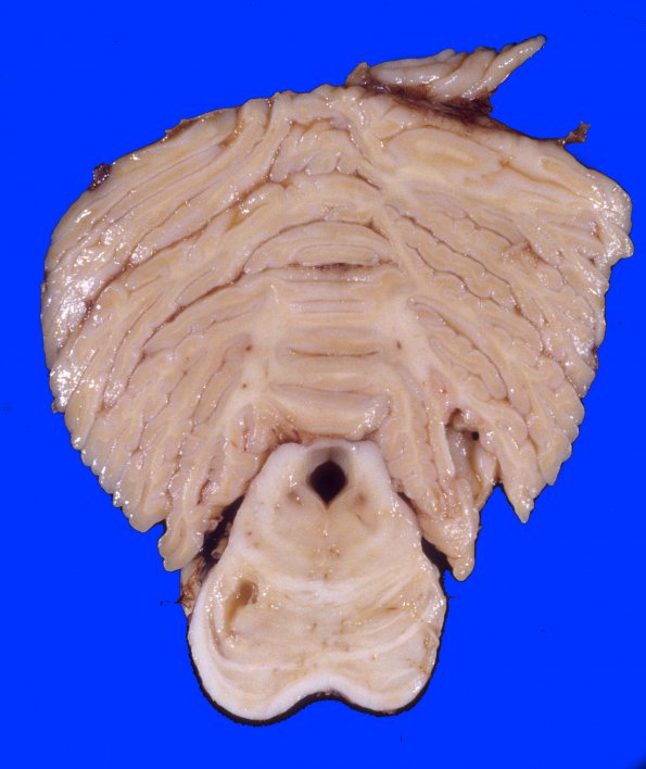 10C Infarcts, Lacunar (Case 10C) 1