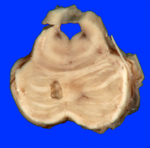 10D1 Infarct, remote (Case 10D1) gross_4