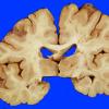 11A1 Infarct, lacunar (Case 11A1) 1