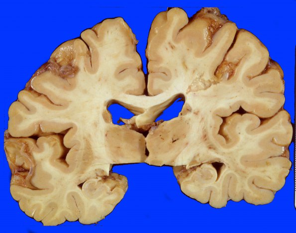 11A1 Infarct, lacunar (Case 11A1) 1