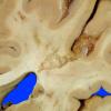 11A2 Infarct, lacunar (Case 11A2) 2