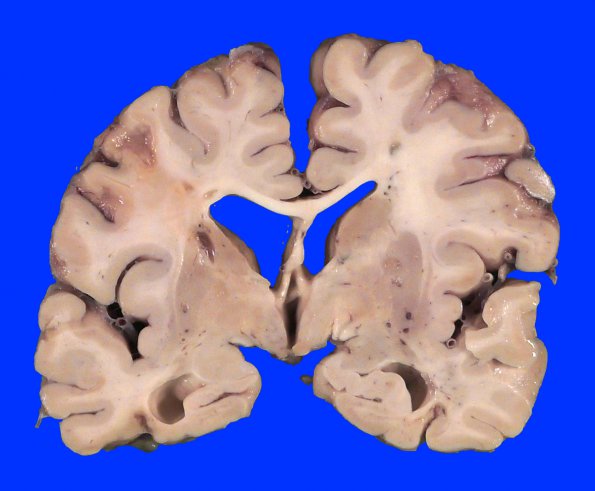 1A2 Infarcts, multiple, oldest 10 years (Case 1)_7