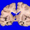 1A3 Infarcts, multiple, oldest 10 years (Case 1)_9