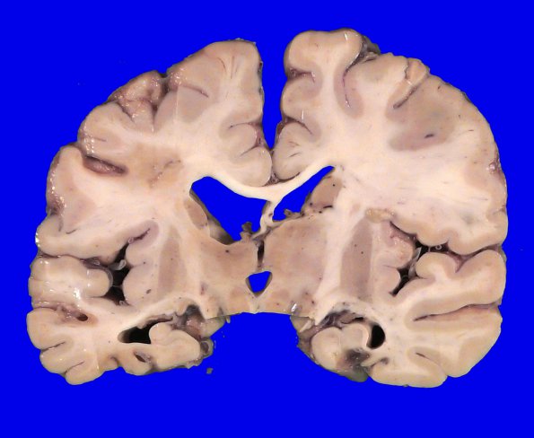 1A3 Infarcts, multiple, oldest 10 years (Case 1)_9