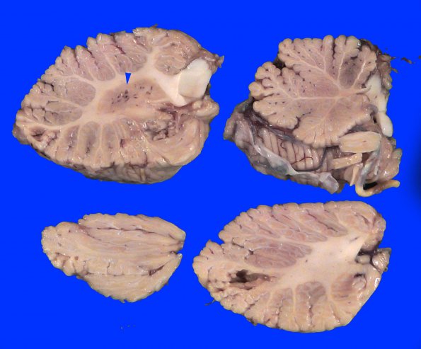 1A4 Infarcts, multiple, oldest 10 years (Case 1) copy