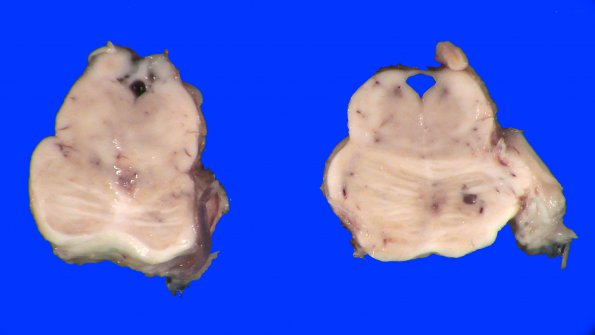 1A6 Infarcts, multiple, oldest 10 years (Case 1)_18