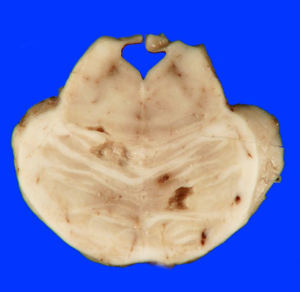 3B2 Infarcts, lacunar, Arteriolo, HT & AIDS (Case 3) 5