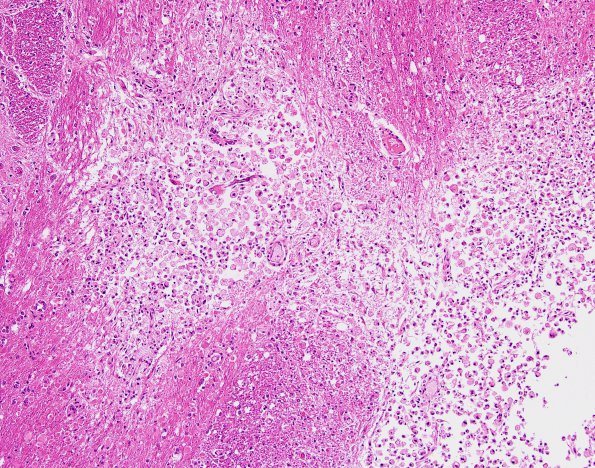 3C2 Infarcts, lacunar, Arteriolo, HT & AIDS (Case 3) H&E 6