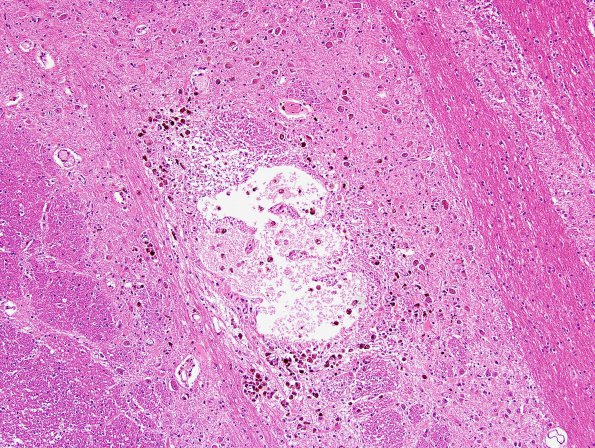 3C3 Infarcts, lacunar, Arteriolo, HT & AIDS (Case 3) H&E 5