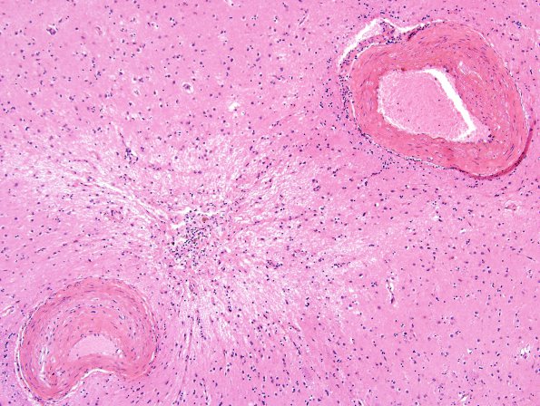 3C4 Infarcts, lacunar, Arteriolo, HT & AIDS (Case 3) H&E 2