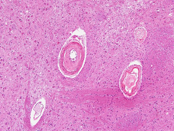 3C5 Infarcts, lacunar, Arteriolo, HT & AIDS (Case 3) H&E 9