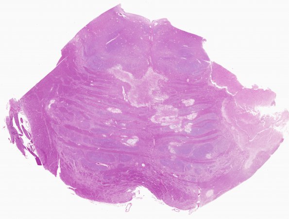 4A1 Infarct, Lacunar (Case 4) 1 H&E whole mount