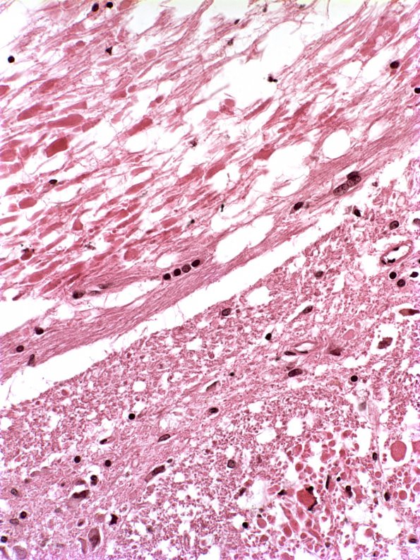 4A4 Infarct, Lacunar (Case 4) e