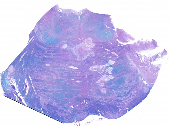 4B1 Infarct, Lacunar (Case 4) 1 LFB-PAS whole mount