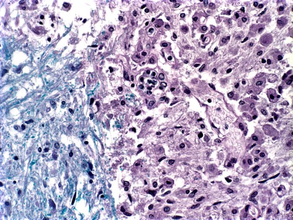 4B3 Infarct, Lacunar (Case 4) i