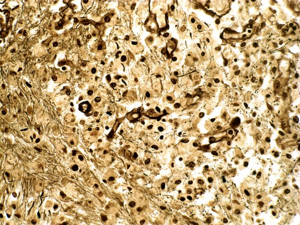 4B4 Infarct, Lacunar (Case 4) h