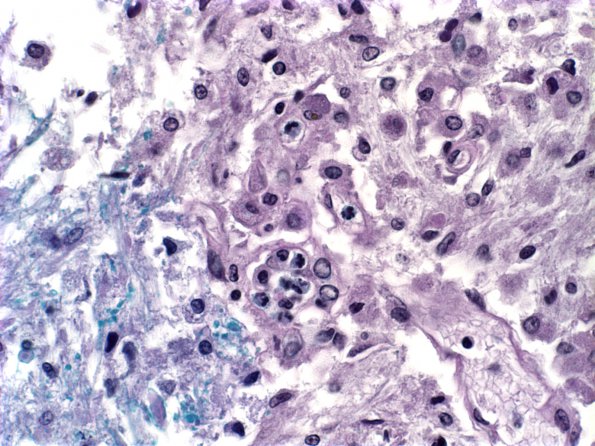 4B5 Infarct, Lacunar (Case 4) g