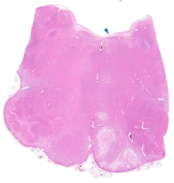 5A1 Infarct, Pyramid (Case 5) H&E WM copy