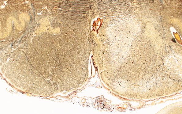 5B3 Infarct, Pyramid (Case 5) Biels 2X